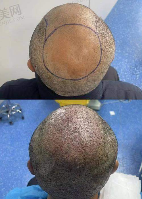 一、太原显微植发医院正规吗？