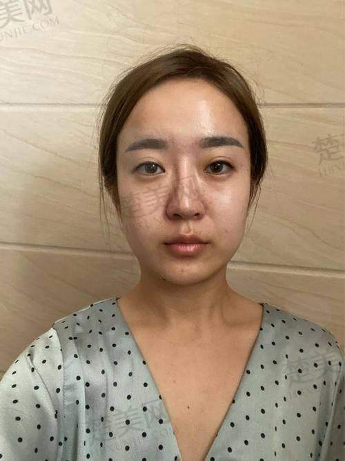 一、鼻子填玻尿酸的原理和适用情况