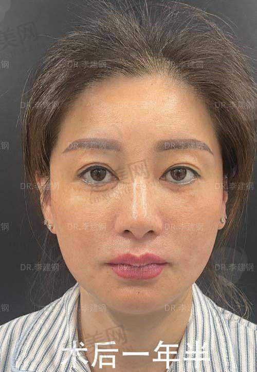 四、选择面部提升医院的注意事项