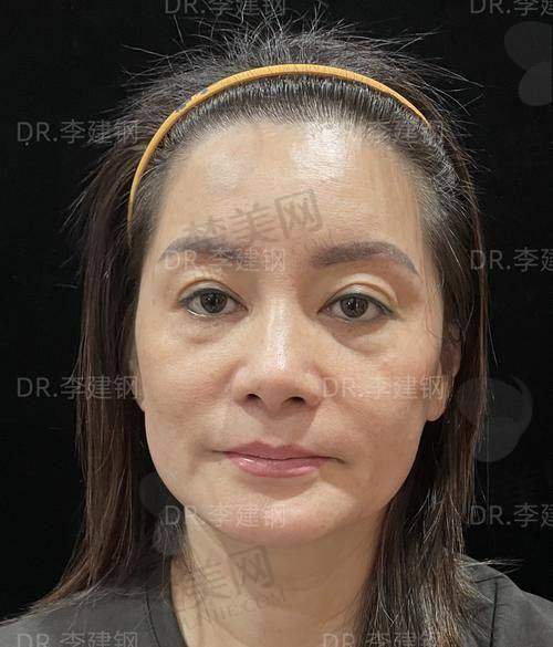 二、杭州瑞丽蹇洪医师真实术例：「值回票价」的三大理由