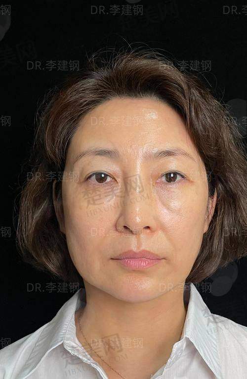 四、杭州瑞丽蹇洪医师口内提升技术：适合哪些人？