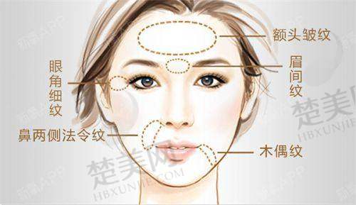 一、去皱针和玻尿酸的成分区别