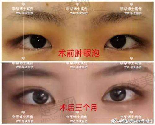 三、成都双眼皮修复医生排行榜前十名之杜园园医生