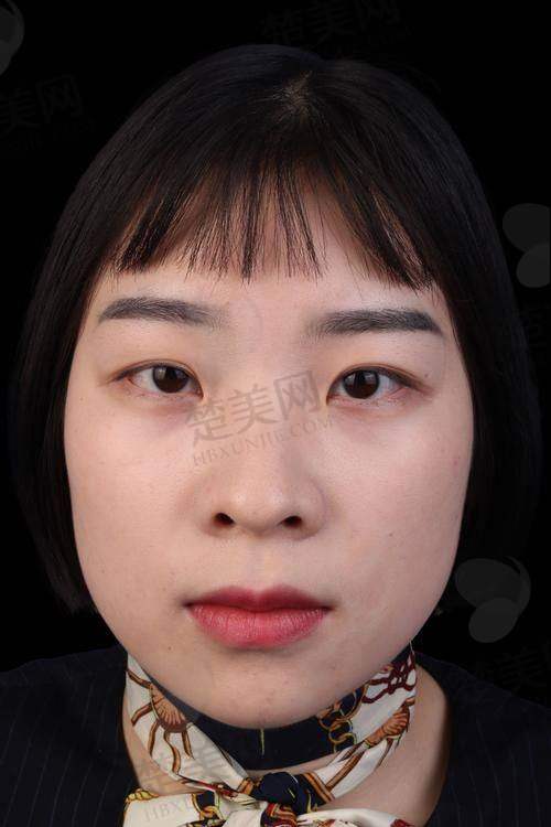 五、选择眼综合手术的注意事项