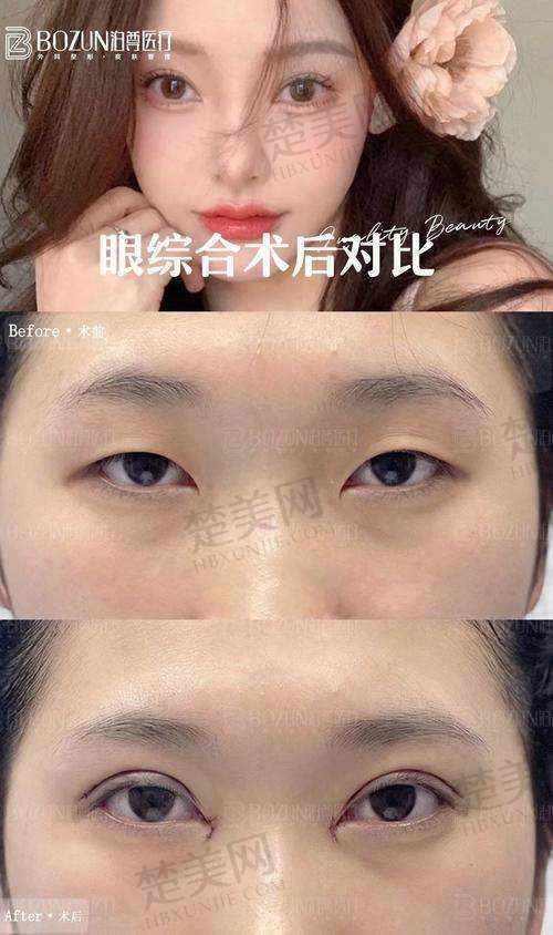 三、眼综合手术的具体项目及技术特点