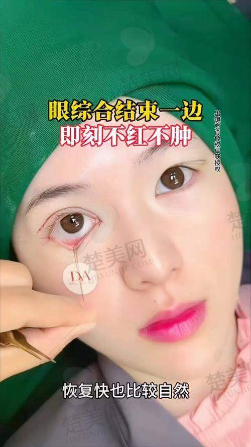 四、李哲权医生做眼综合的优势