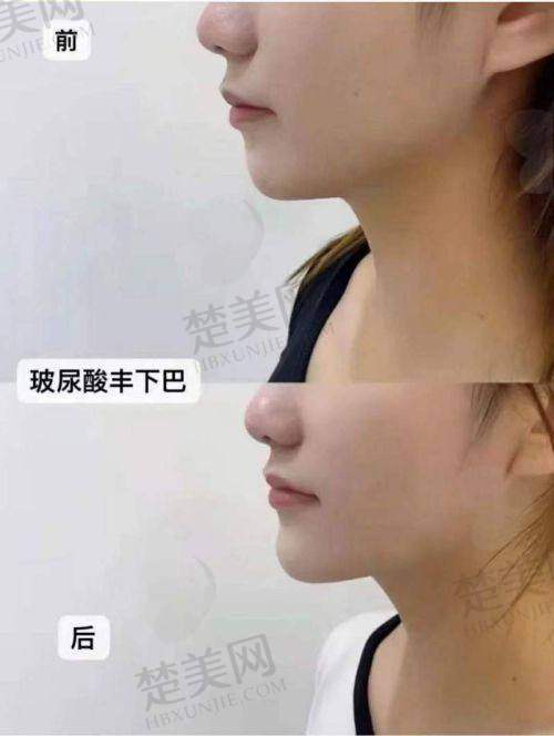 三、玻尿酸丰下巴注射的关键步骤