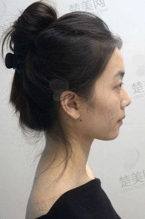 二、影响玻尿酸填充下巴维持时间的因素