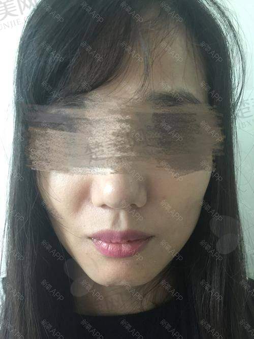二、玻尿酸丰下巴注射前的准备工作