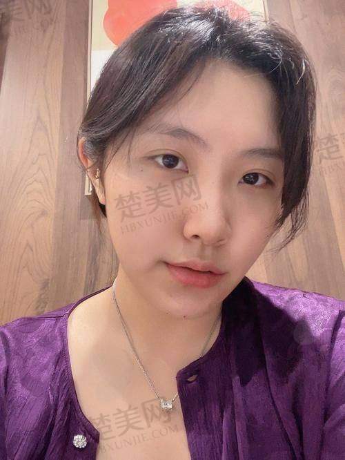 五、玻尿酸丰下巴注射的成效维持与后续调整