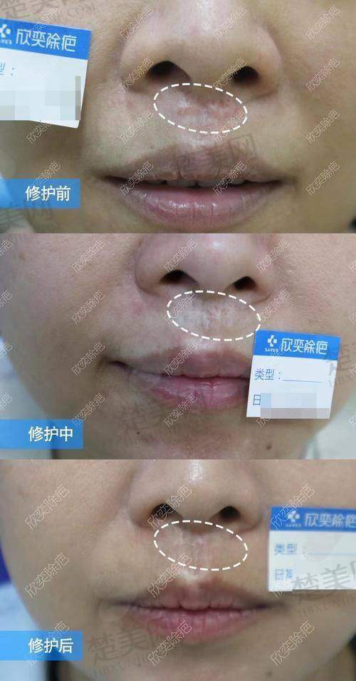 一、于艳菊医生——经验多技术强，光纤祛疤疙瘩疗效显著