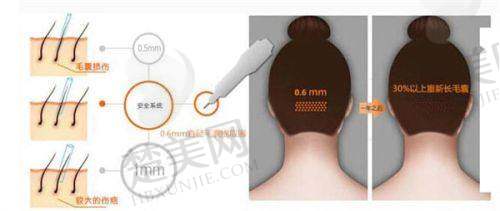 七、河南郑州华仁植发中 心：特制药剂成效好