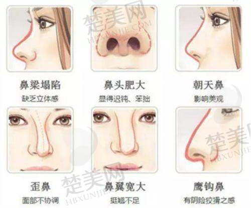 五、如何预约李希军 医生做鼻子