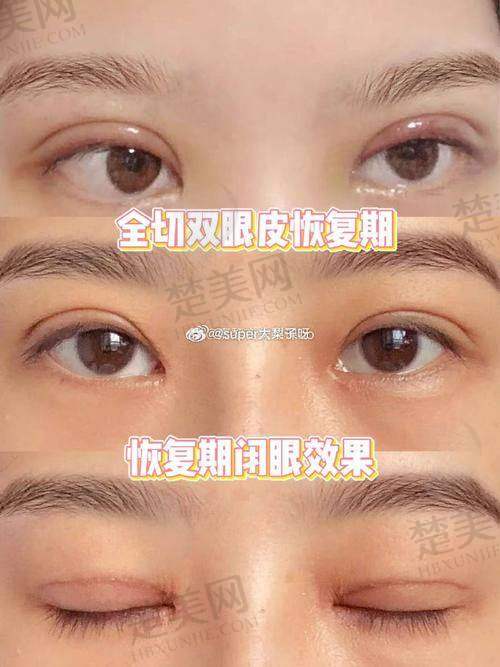 三、广州韩妃李光琴双眼皮手术成效展示