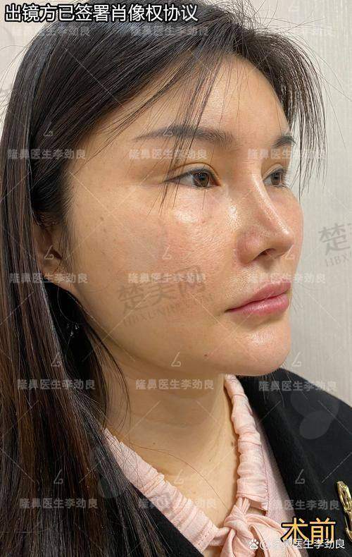 二、杭州何涛医生隆鼻技术优势