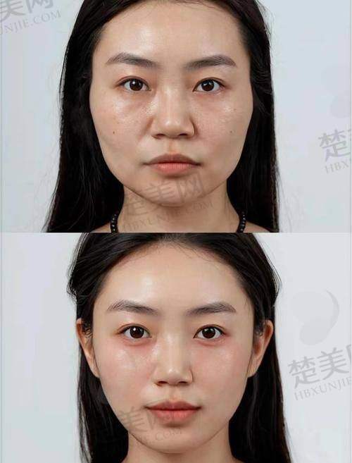 四、北京美天医疗美容——综合治疗馒化脸的实力医院