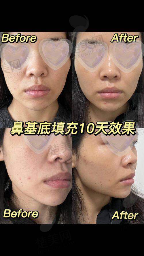 一、小分子艾莉薇玻尿酸基本介绍