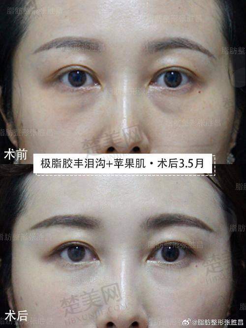 二、王自谦医生面部脂肪修复实例展示