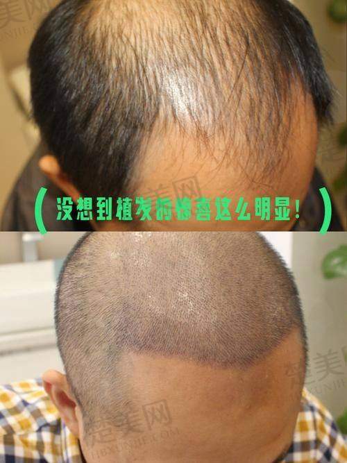 一、河南郑州华仁植发：正规靠谱的毛发专科研究院