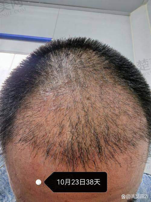 七、重庆雍禾植发