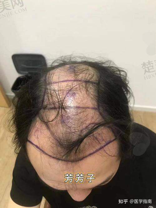 六、重庆华美植发