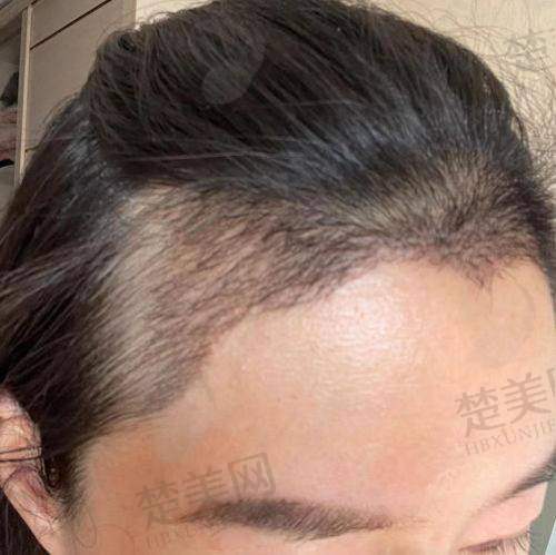 四、重庆华肤皮肤病医院植发科