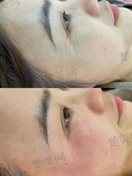 三、常双明脂肪填充的成效保护