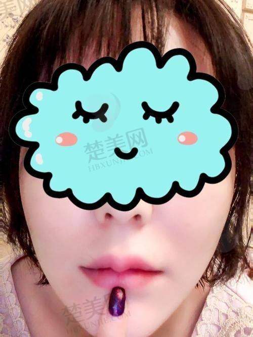 二、影响韩式嘟嘟唇价格的因素