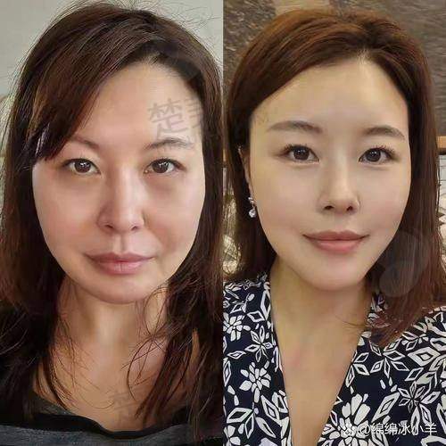 四、上海王洪内窥镜拉皮提升口碑炸裂：患者和行业如何“反黑”
