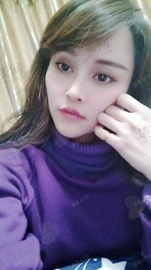 二、影响自体丰法令纹价格的常见因素