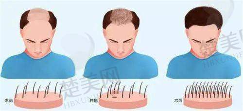 十、成都毛发种植哪家医院强之成都雍禾植发门诊部