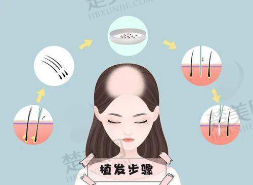 七、成都毛发种植哪家医院强之成都恒博植发门诊部