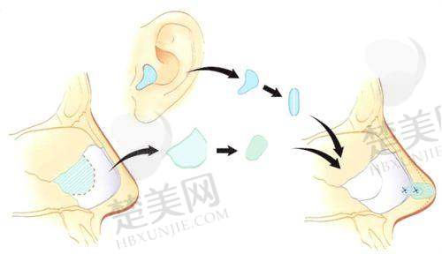 二、成都耳朵畸形再造哪家医院好？