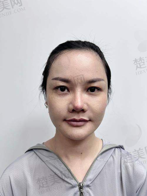 一、30岁开始有法令纹，这些成因要知道