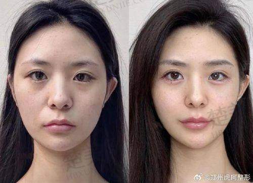 五、使用乔雅登雅致和极致的注意事项