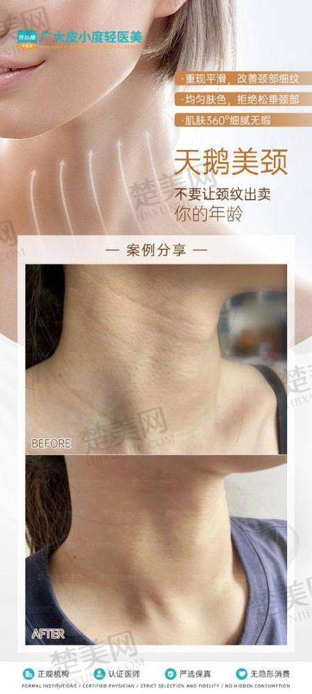三、常见医美手段去除颈纹的成效