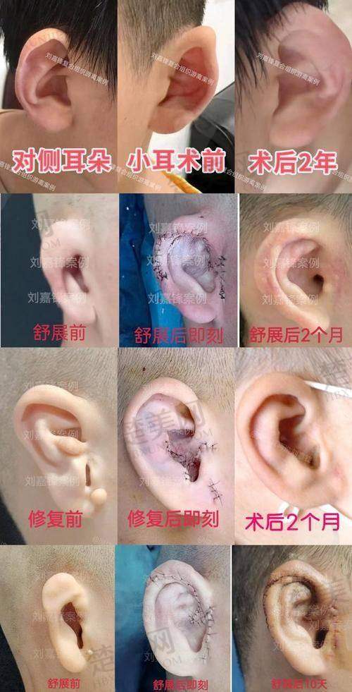 三、成都耳朵畸形再造真人实例分享