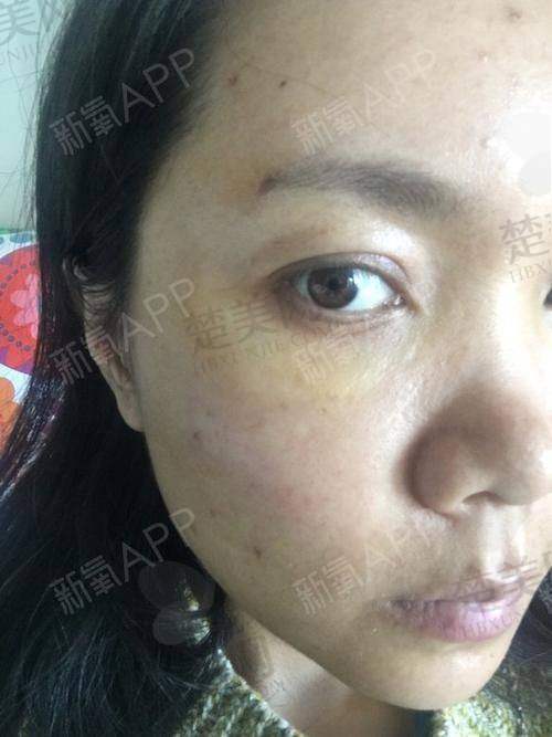 四、填充下巴的注意事项