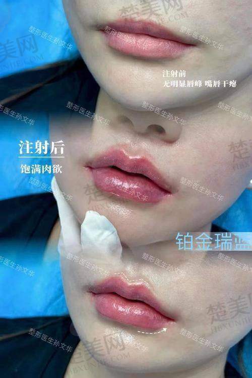 三、乔雅登玻尿酸5型的正版价格