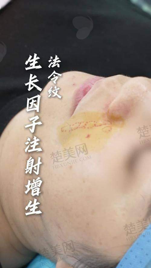 二、不同类型法令纹的改善方案