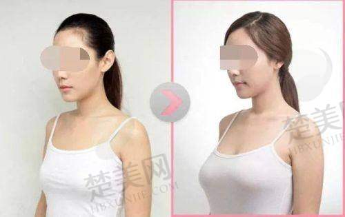 二、泰国二合一丰胸针男生打有无用