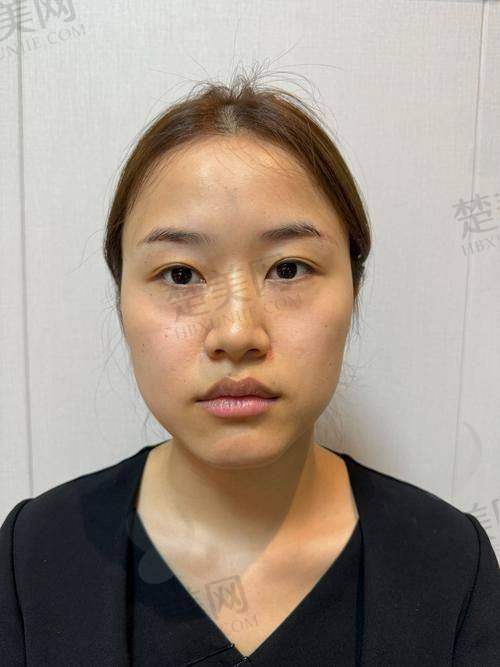 三、玻尿酸在医美领域的广泛应用