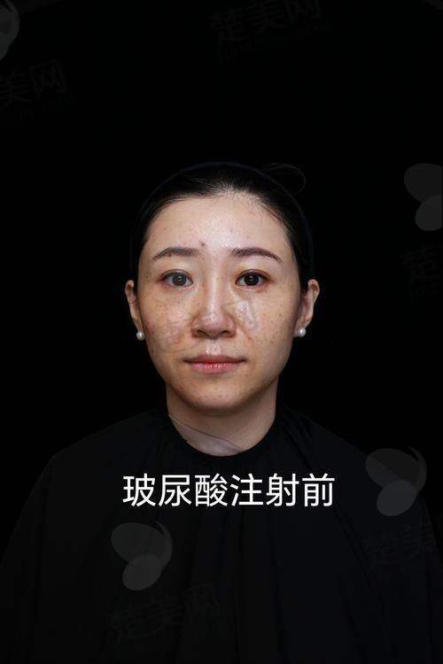 三、尿酸高吃什么好的快之需严格避免的食物