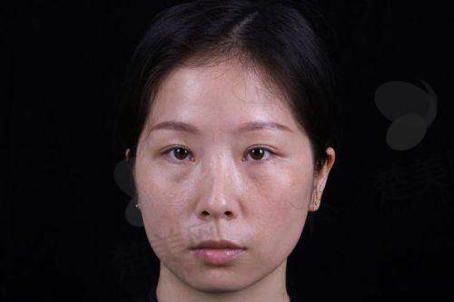 四、南宁健丽医美祛眼袋顾客真实评价大分享