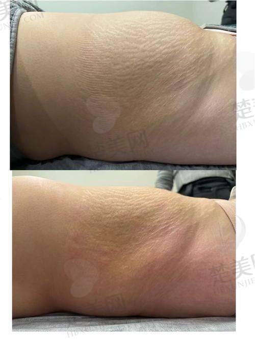 七、吸脂术后注意事项