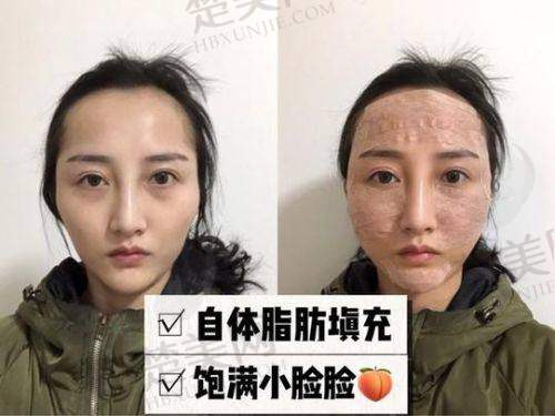 二、北京专门做脂肪填充的五大医院排名及特色