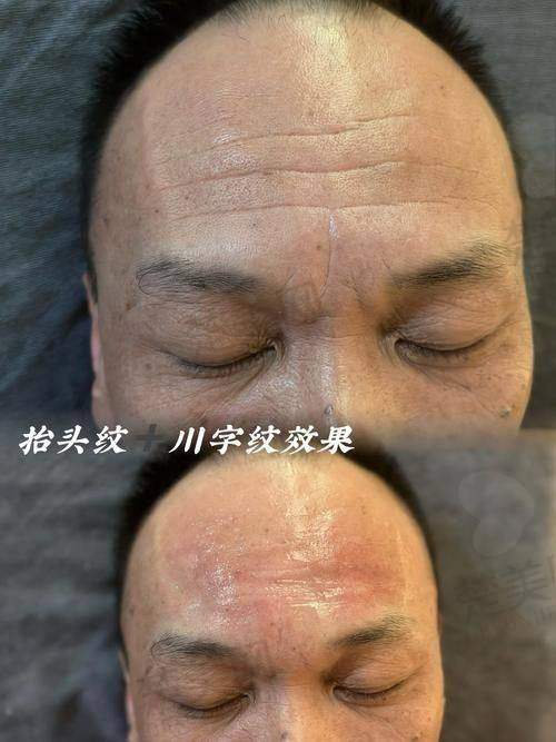 七、抬头纹怎么淡化：总结与建议