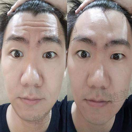 二、不同类型抬头纹的解决方案（轻医美为主）