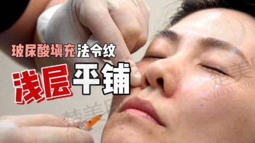 玻尿酸去除法令纹好吗？