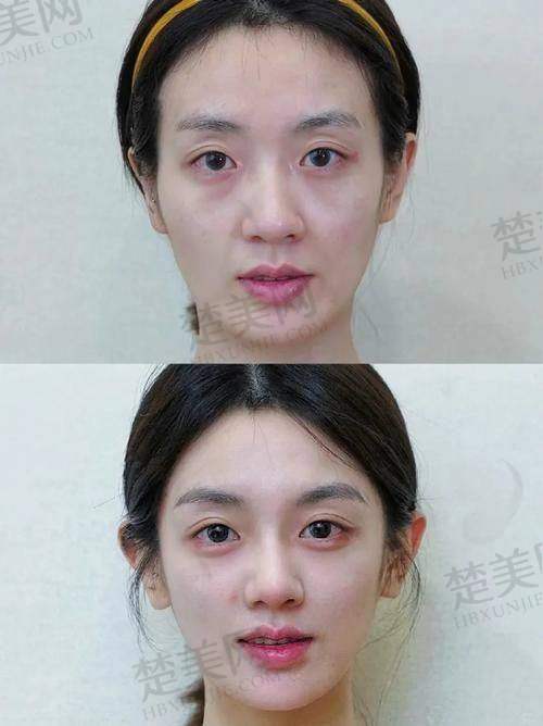 五、上海伯思立医疗美容——上海玻尿酸填充个性化服务典范